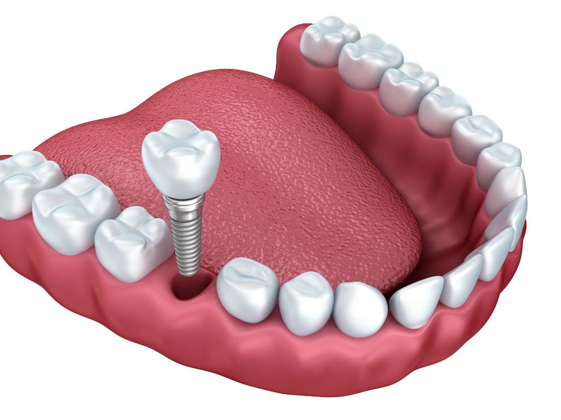 Dental Implants South Pasadena FL
